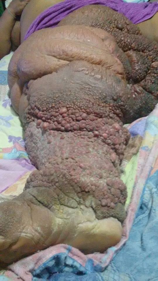 Linfedema chega a pesar quase 60kg (Reprodução/Arq. Pessoal)