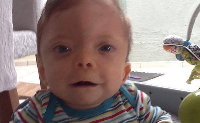 Com síndrome rara, bebê de Águas de S. Pedro precisa de cirurgia de R$ 143 mil