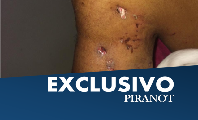 Em Piracicaba, mulher é atacada por cachorro pitbull e fica gravemente ferida