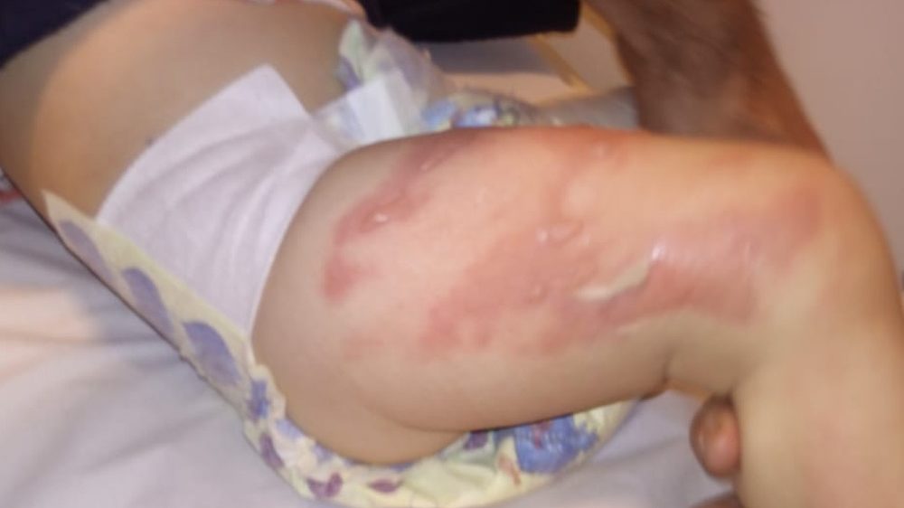 Em Limeira, bebê de 11 meses meses sofre queimaduras nas pernas em creche