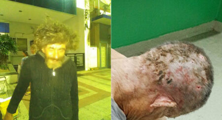 Morador de rua é encontrado com 92 larvas no couro cabeludo, em Peruíbe
