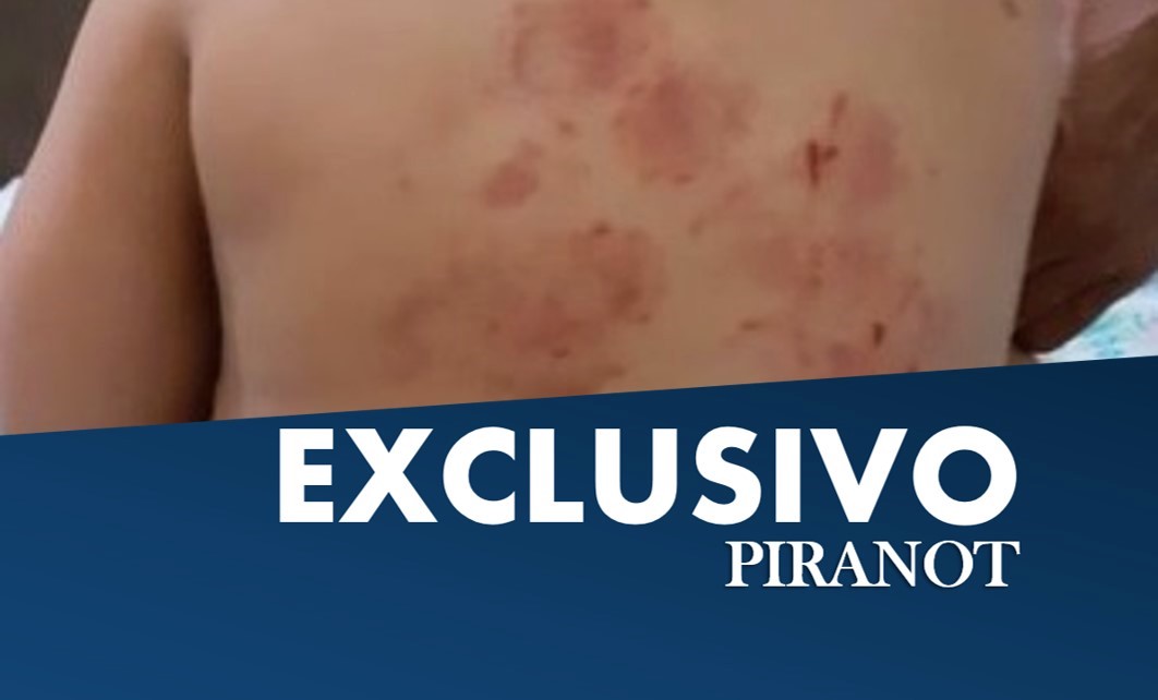 Bebê de um ano volta de escola em Piracicaba com mais de 15 mordidas pelo corpo