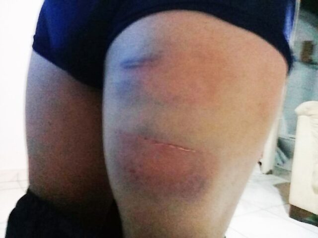 graves agressões nos braços, nas pernas e nas costas