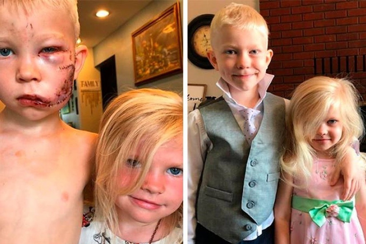 Menino de seis anos leva mais de 90 pontos no rosto após salvar irmã de ataque de cachorro