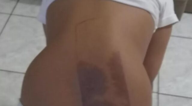 Uma foto da criança com as costas queimadas pelo celular Uma foto da criança com as costas queimadas pelo celular