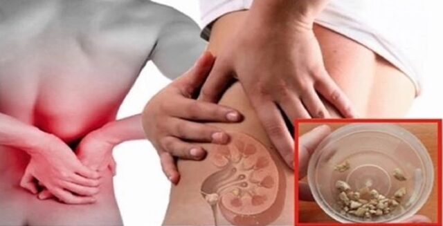 Uma foto ilustrando pedras nos rins