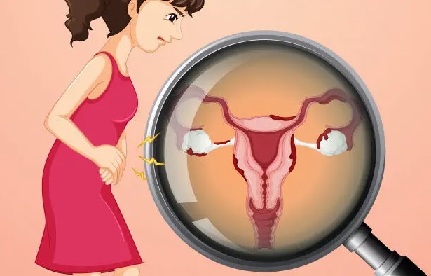 Câncer de ovário é silencioso e pode evoluir depressa se não tratado em estágio inicial: entenda a doença