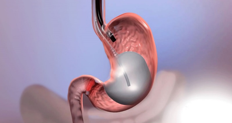 Tudo o que você precisa saber sobre balão gástrico