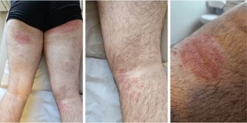 Foto: Veasey et al., 2025/Anais Brasileiros de Dermatologia