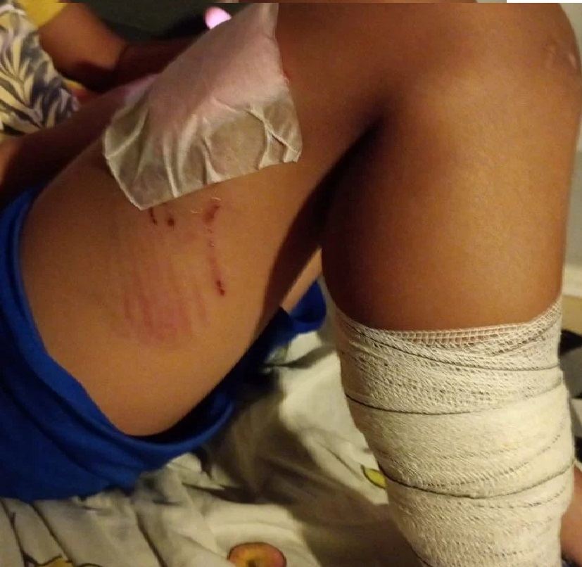 Três crianças são atacadas por pitbull dentro de condomínio