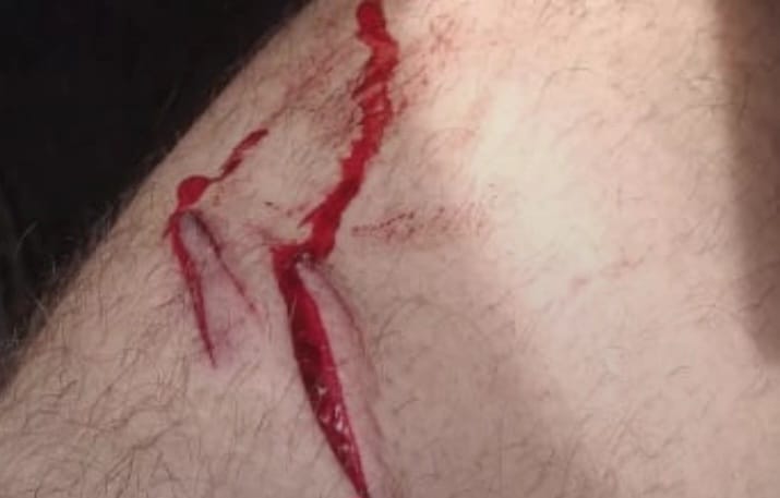 Homem é atacado por onça no quintal de casa em Charqueada; cães salvaram a sua vida