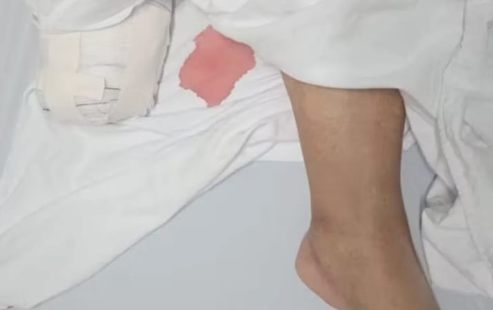 Homem tem pé amputado após pisar em brinco