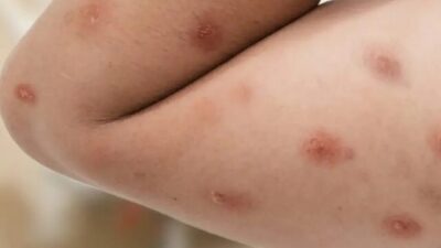 Piracicaba registra caso suspeito de mpox; resultado do exame é aguardado