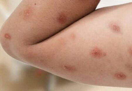 Piracicaba registra caso suspeito de mpox; resultado do exame é aguardado