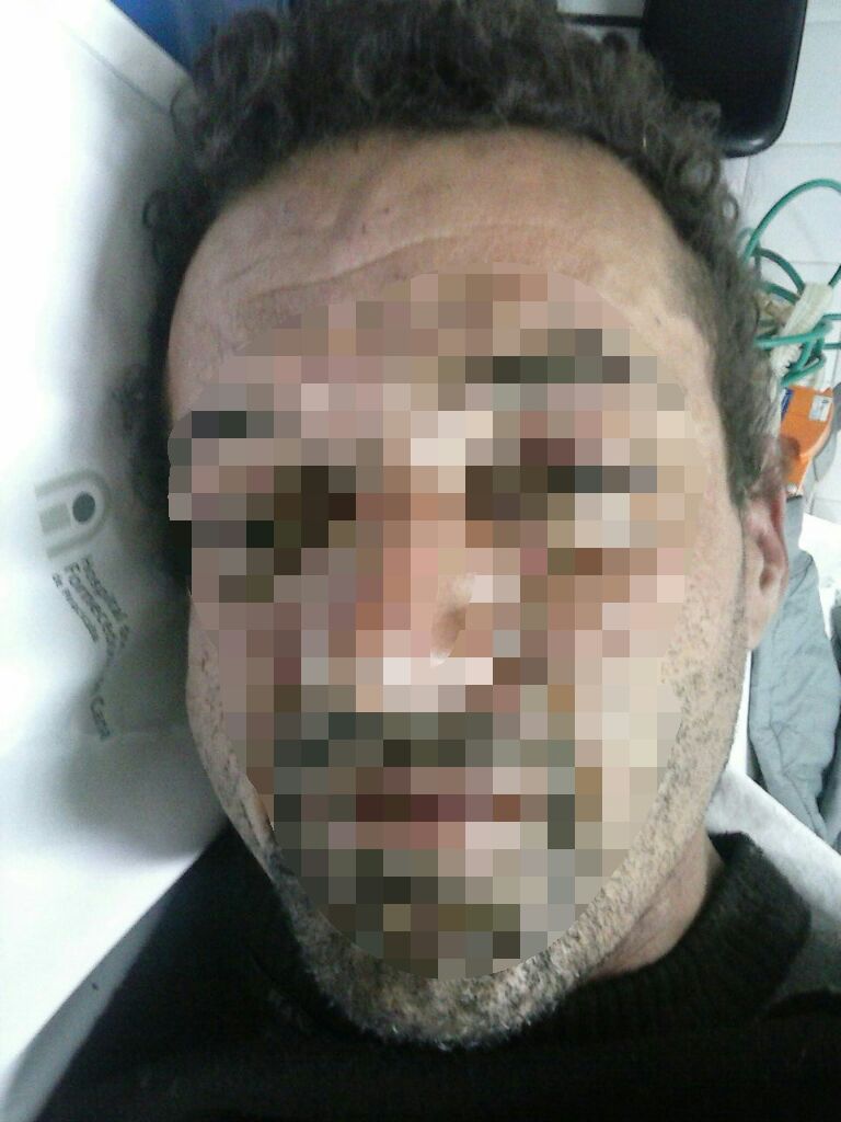 Foragido é preso após dar entrada em UPA com garrafa no anus